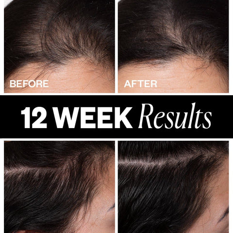 SPONSORED Hair Density Scalp Treatment — Retail 4
